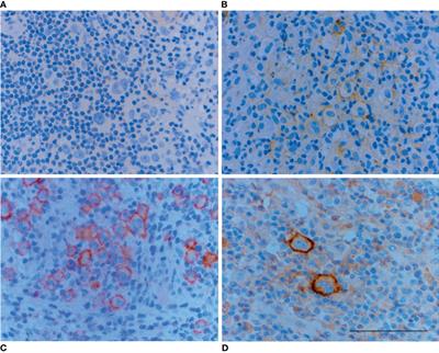 Somatostatin Receptors and Chemokine Receptor CXCR4 in Lymphomas: A Histopathological Review of Six Lymphoma Subtypes